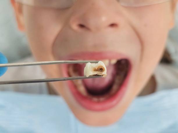 Best Emergency Tooth Extraction in Franklin Lakes, NJ